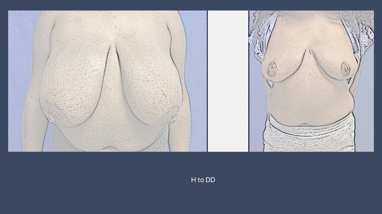 Dr Suzman Plastic Surgery resu